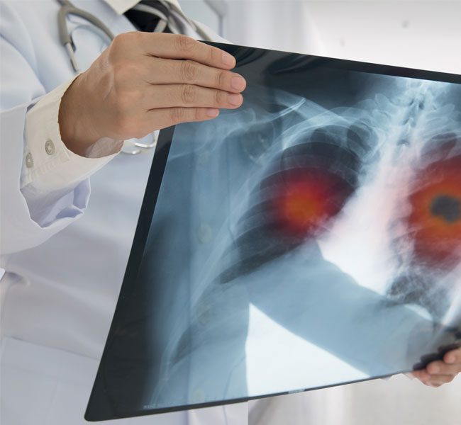 Cancer Misdiagnosis